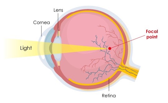 what are refractive errors of vision and what causes them